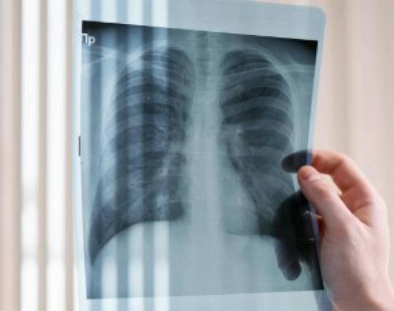 Lung cancer on the rise in younger Spaniards, especially in women