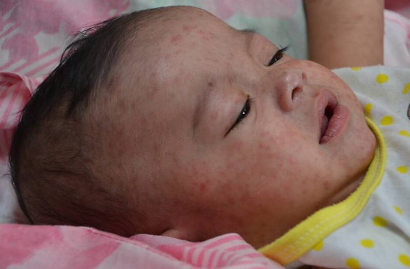 Spain sees early surge in measles cases as experts warn of spring spread risk